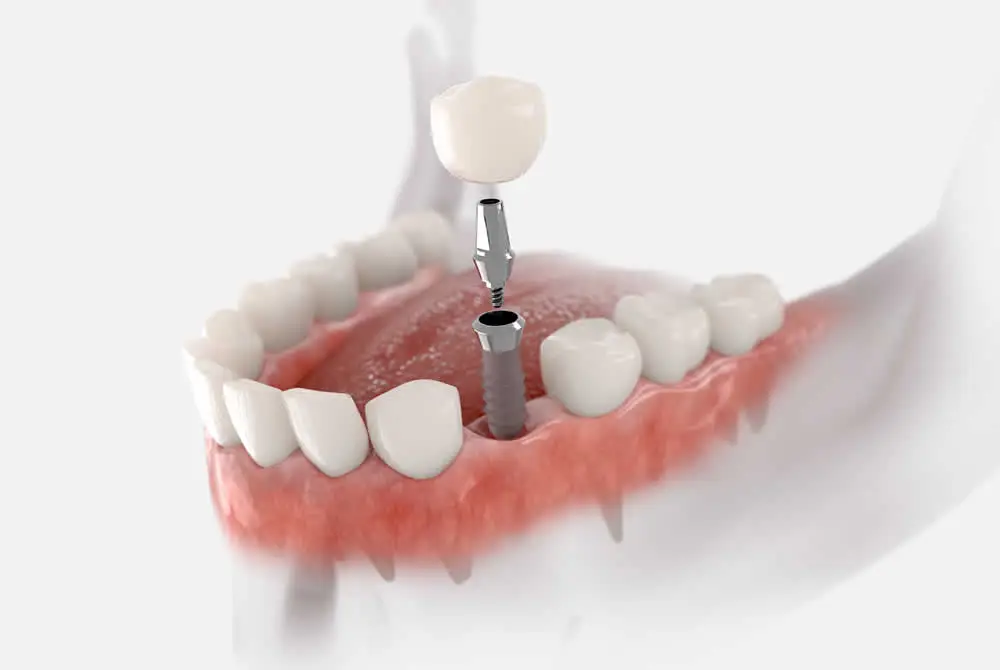 Single Dental Implant