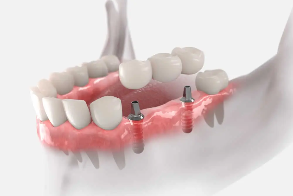 Implant Bridge