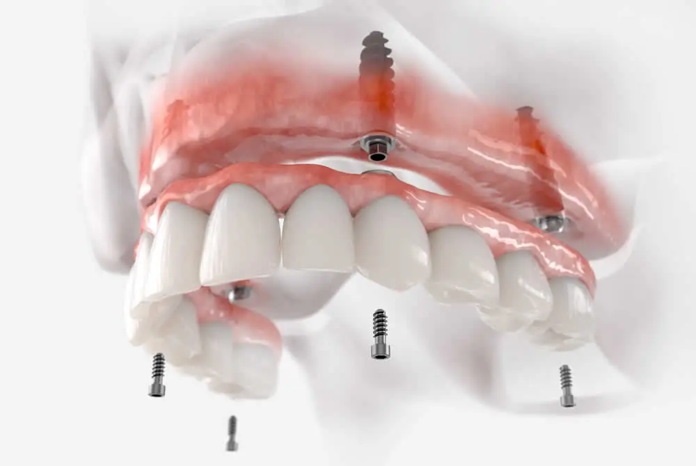 Teeth in a Day