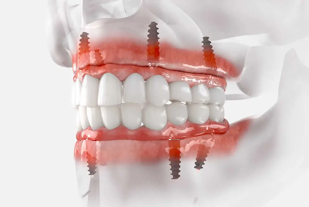 Full Arch / All-on-4 Implants
